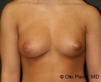 Breast Augmentation with Fat Grafting after 574429