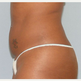 UltraShape after 1549466
