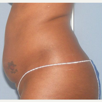 UltraShape before 1549466