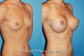 Breast Augmentation - Silicone Implants after 1053340