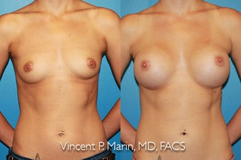 Breast Augmentation - Silicone Implants before 1053340