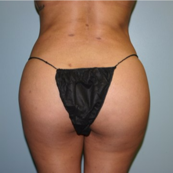 Brazilian Butt Lift after 3667388