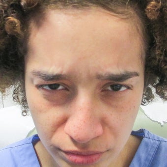 25-34 year old woman treated with Botox 1834383