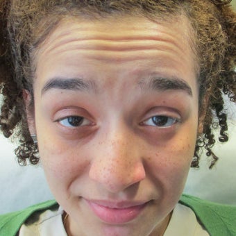25-34 year old woman treated with Botox before 1834383