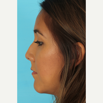 25-34 year old woman treated with Rhinoplasty before 3690949