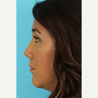 25-34 year old woman treated with Rhinoplasty after 3690949