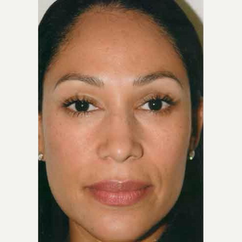 35-44 year old woman treated with Rhinoplasty after 3406187