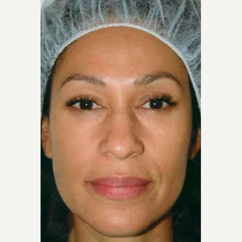 35-44 year old woman treated with Rhinoplasty before 3406187