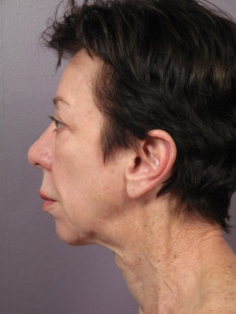 Eyelid Surgery before 280833