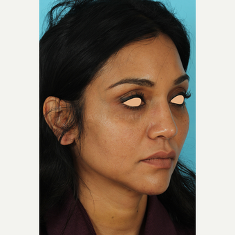 25-34 year old woman treated with Revision Rhinoplasty after 3691226