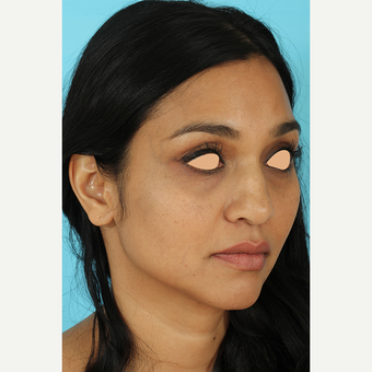 25-34 year old woman treated with Revision Rhinoplasty before 3691226