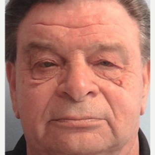 65-74 year old man treated with Ptosis Surgery before 3727884