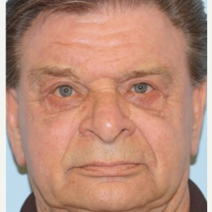 65-74 year old man treated with Ptosis Surgery after 3727884