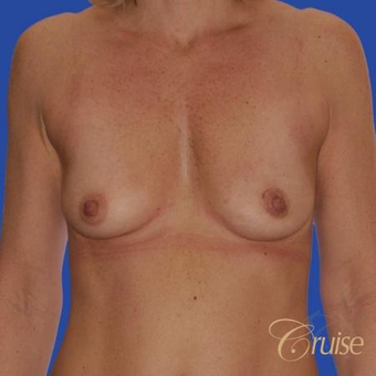 47 year old treated with a Donut Breast Lift and Implants before 3501301