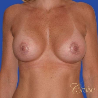 47 year old treated with a Donut Breast Lift and Implants after 3501301