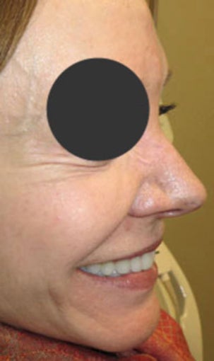 64-year-old before and after Botox for crow's feet after 1428614