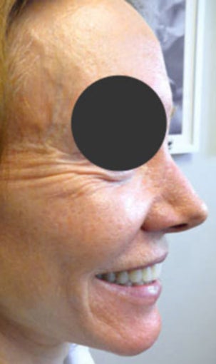 64-year-old before and after Botox for crow's feet before 1428614