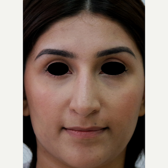 25-34 year old woman treated with Rhinoplasty after 3637853
