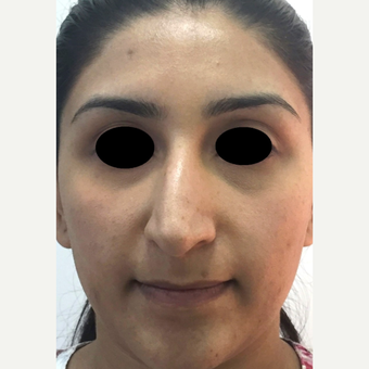 25-34 year old woman treated with Rhinoplasty before 3637853