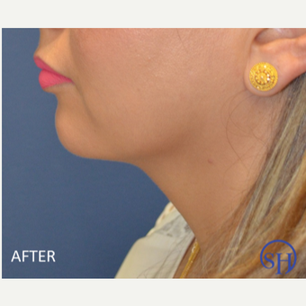 After 1 treatment Kybella after 2879265