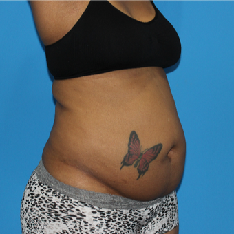 45-54 year old woman treated with Tummy Tuck before 3332967