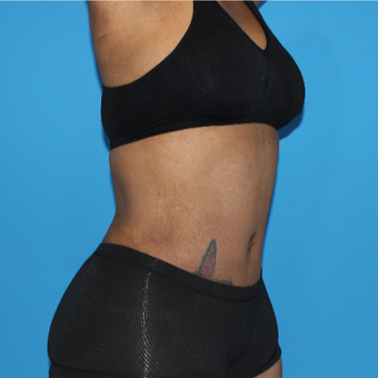 45-54 year old woman treated with Tummy Tuck after 3332967