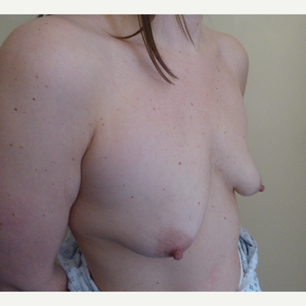 25-34 year old man treated with Breast Lift before 3428120