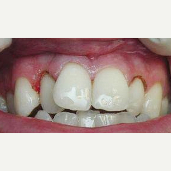Veneers and Crown before 3097461