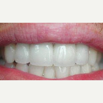 Veneers and Crown after 3097461