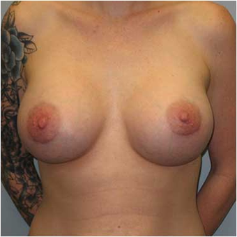 27 year old woman treated with Breast Augmentation after 3468224