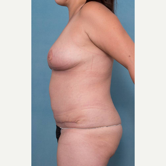 25-34 year old woman treated with Mommy Makeover after 3341656