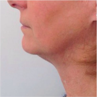 45-54 year old woman treated with Kybella after 2463270