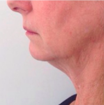 45-54 year old woman treated with Kybella before 2463270