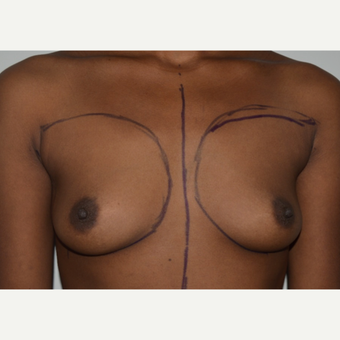 25-34 year old woman treated with Breast Augmentation before 3073394