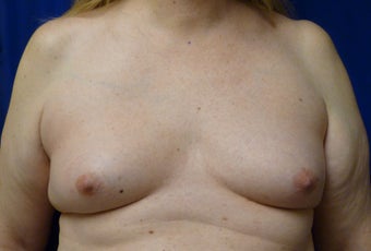 57 Year Old MTF Top Surgery before 1269946
