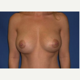 35-44 year old woman treated with Breast Augmentation after 3220051