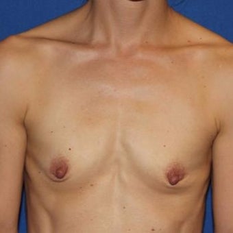 35-44 year old woman treated with Breast Augmentation before 1970657