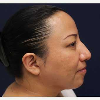 35-44 year old woman treated with Smart Lipo after 3143272