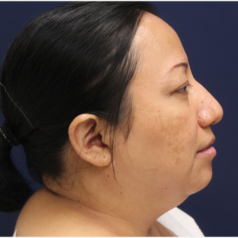 35-44 year old woman treated with Smart Lipo before 3143272