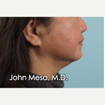 55-64 year old woman treated with Buccal Fat Removal before 3777322