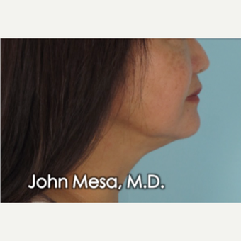 55-64 year old woman treated with Buccal Fat Removal after 3777322