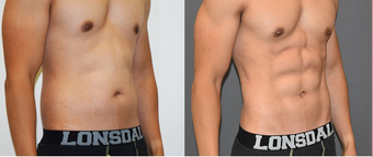 25-34 year old man treated with Vaser Liposuction before 4599289