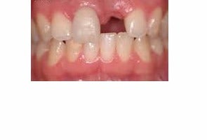 Front tooth replaced with Dental Implants before 3696484