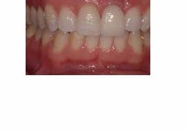 Front tooth replaced with Dental Implants after 3696484