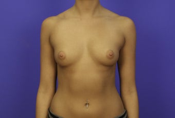 18-24 year old woman treated with Breast Augmentation 3476158
