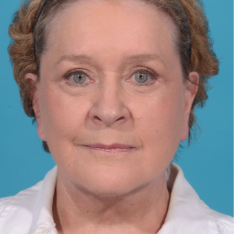 72 year old woman treated with Facelift/necklift, upper eyelid blepharoplasty after 3260366