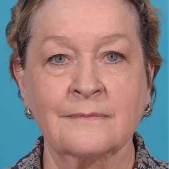 72 year old woman treated with Facelift/necklift, upper eyelid blepharoplasty before 3260366