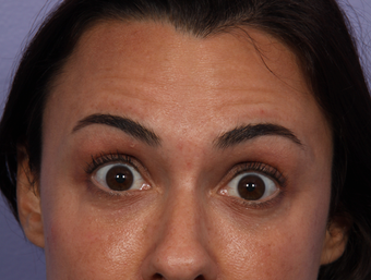 Botox to Forehead before 302212