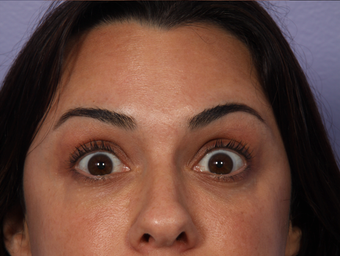 Botox to Forehead after 302212