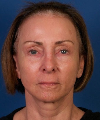 Sculptra Facial Contouring Injections after 1875409